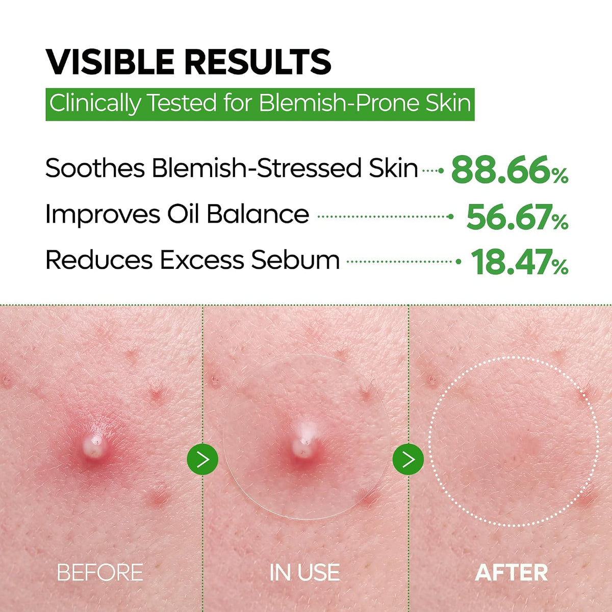 S-ZINC ZERO FIT Ultra Thin Blemish Spot Patch